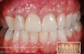 full set of dental implants perth - claremont dental