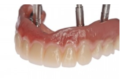 denture implants perth