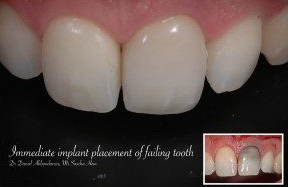photo of front teeth showing the difference of a single tooth implant