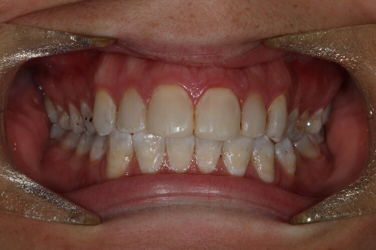 2020-invisalign-perth-after-before-claremont-dental