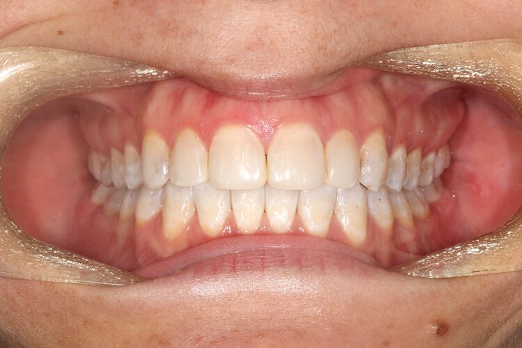 2021-invisalign-perth-after-results-claremont-dental