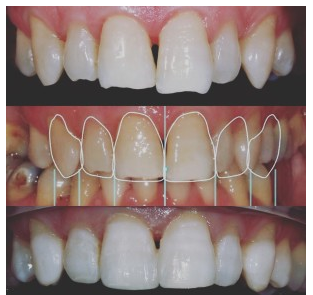 Porcelain Veneers